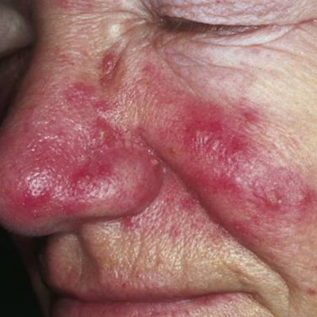 Penyakit Kulit Rosacea, Apa itu?